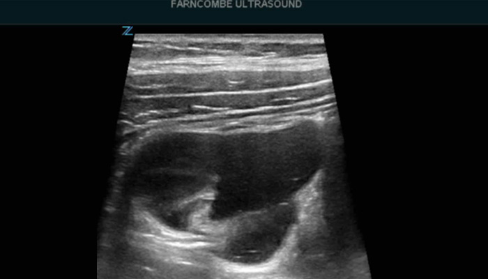 Picture of ultrasound view to investigate colonic dysmotility